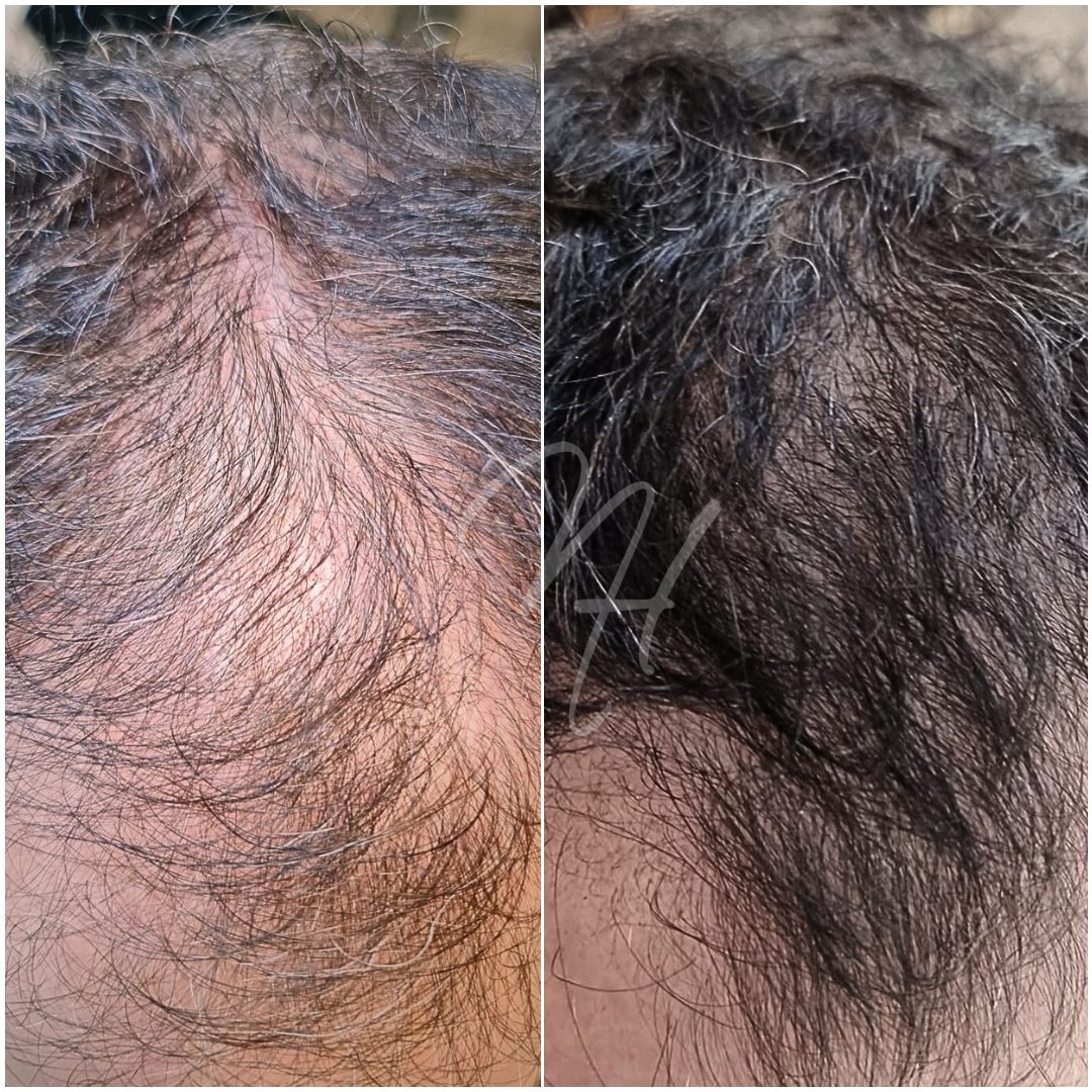 Microneedling & GoldPen &ndash; Beispiel