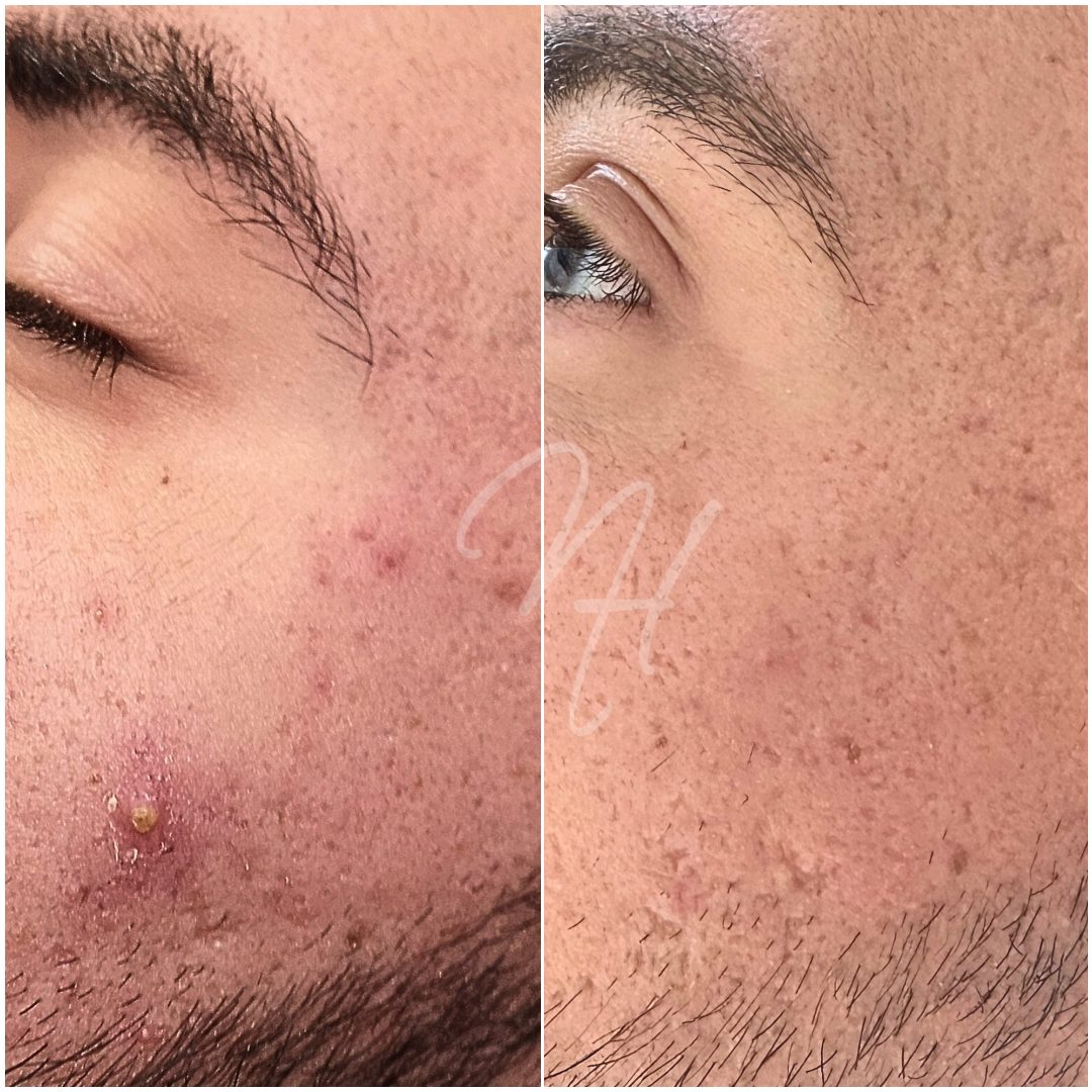 Microneedling & GoldPen &ndash; Beispiel