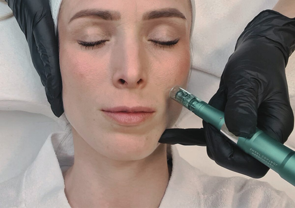 Microneedling & GoldPen &ndash; Art of Beauty Trier