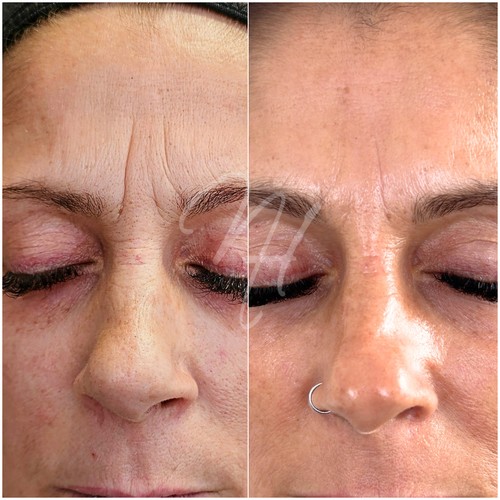 Vorher Nachher — Well-Aging: Fältchen & Hautstraffung (4/7)