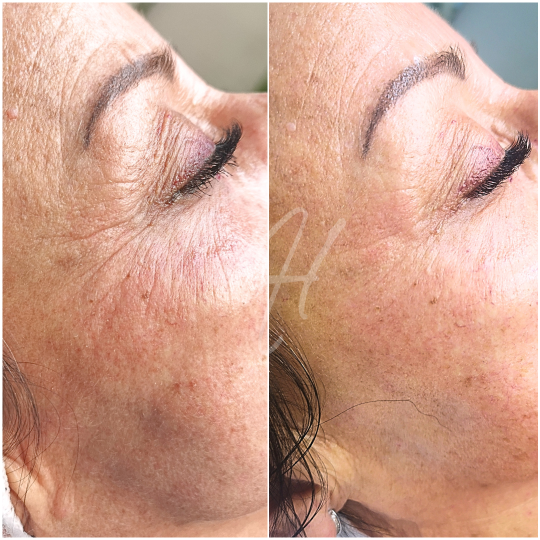 Microneedling Well-Aging Gesicht