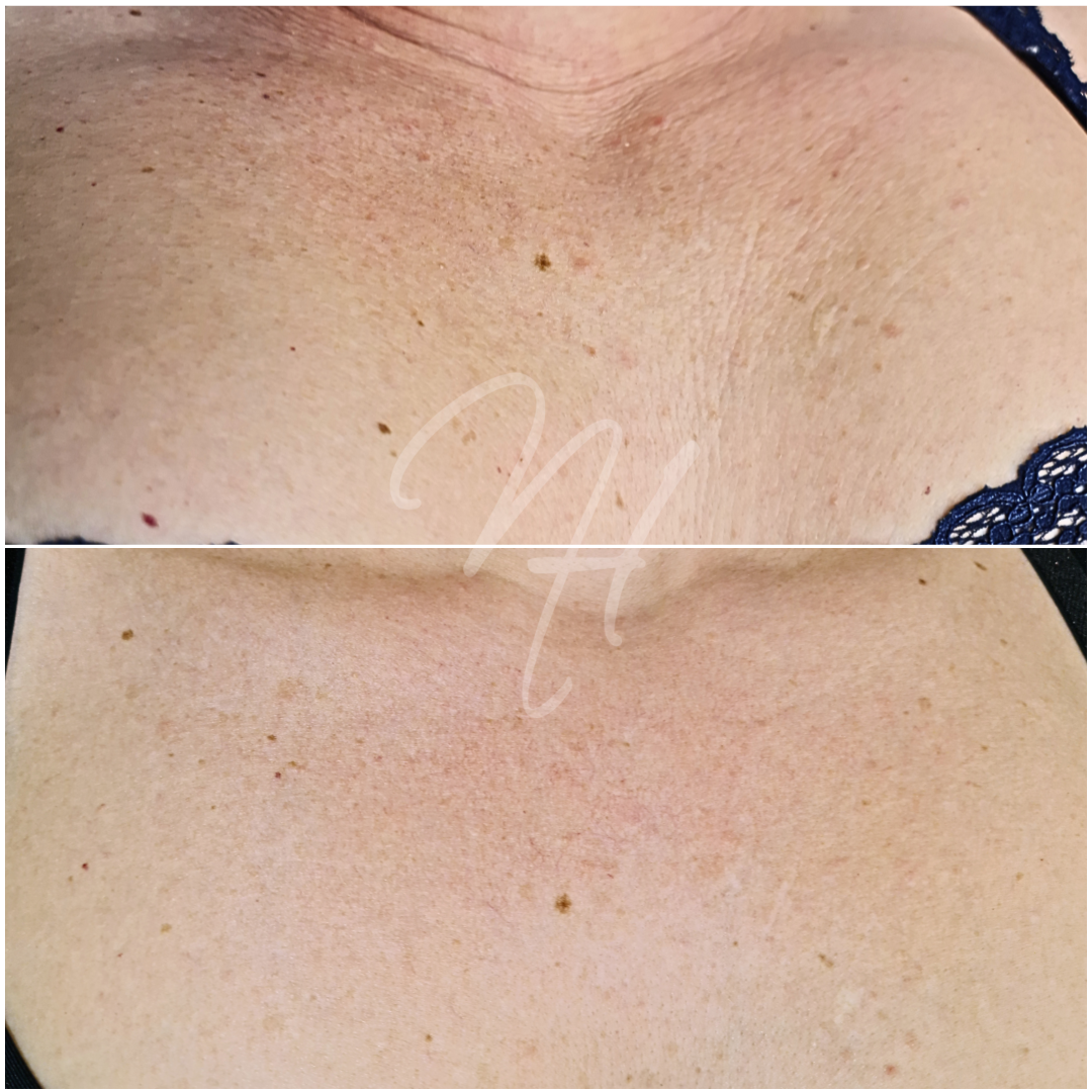 Microneedling Well-Aging Dekolleté