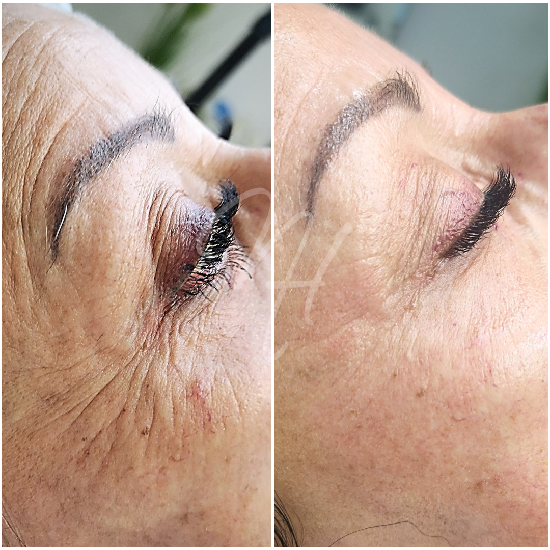 Microneedling Trier – das solltest du wissen