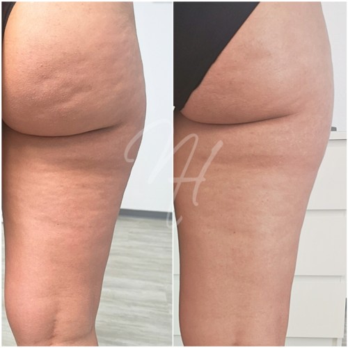 Vorher Nachher — Körper-Needling: Cellulite, Hautbild & Dekolleté (6/10)