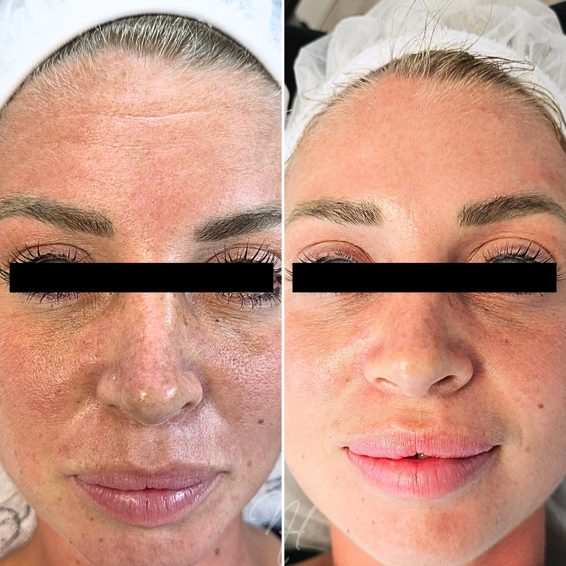 Duo-Microneedling & BioRePeel