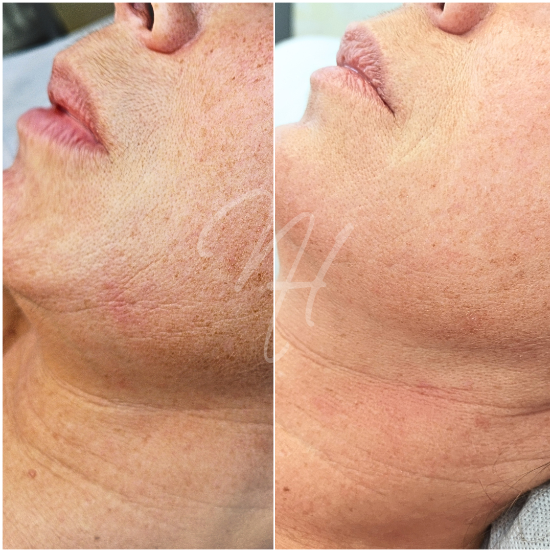Microneedling Well-Aging Hals