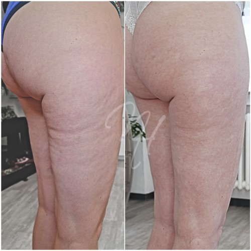 Vorher Nachher — Körper-Needling: Cellulite, Hautbild & Dekolleté (2/10)