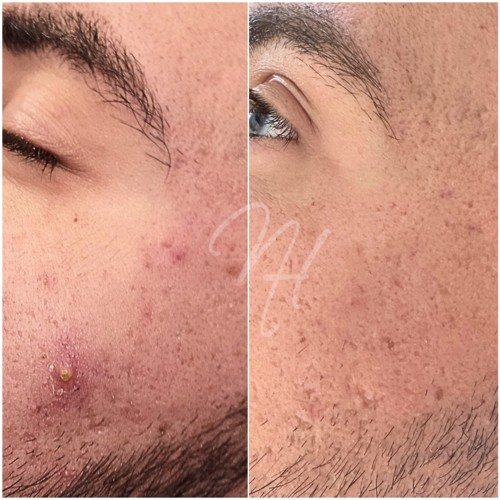 Gepflegtes, ebenmäßiges Hautbild nach Microneedling im Studio Trier