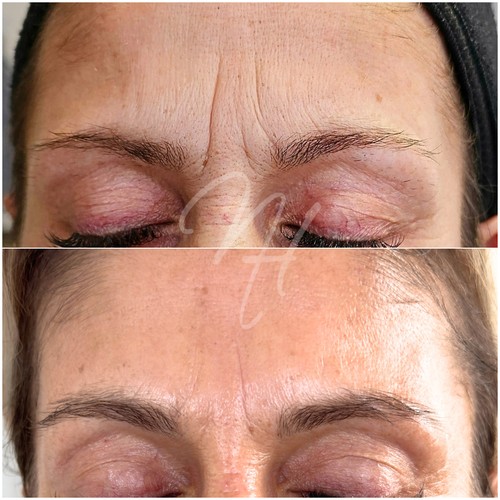 Vorher Nachher — Well-Aging: Fältchen & Hautstraffung (5/7)