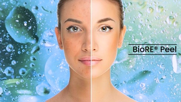 BioRePeel Kurpaket inkl. Hautanalyse – Art of Beauty Trier