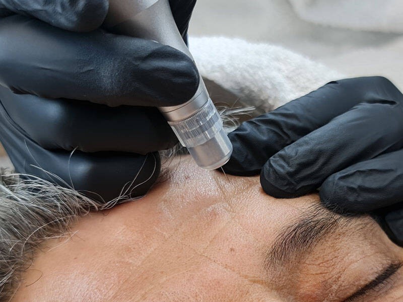 Plasma Pen Lidstraffung in Trier