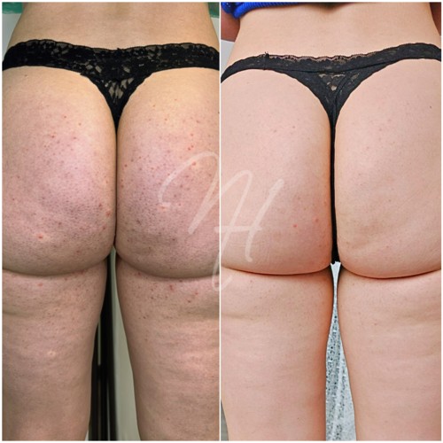 Vorher Nachher — Körper-Needling: Cellulite, Hautbild & Dekolleté (10/10)