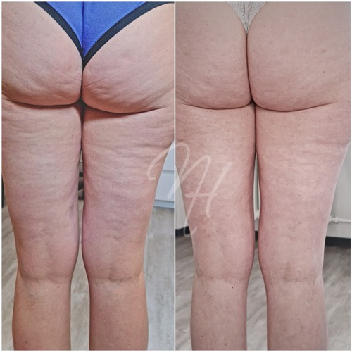 Vorher Nachher — Körper-Needling: Cellulite, Hautbild & Dekolleté (1/10)