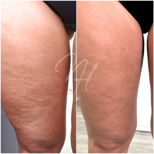 Vorher Nachher — Körper-Needling: Cellulite, Hautbild & Dekolleté (4/10)