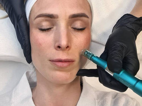 Needling – Natürliche Spannkraft für ein jüngeres Hautbild in Trier