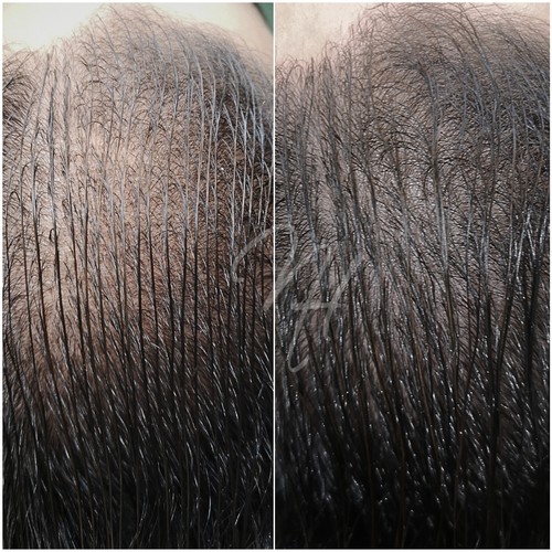 Vorher Nachher — Kopfhaut & Haare (1/5)
