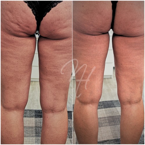 Vorher Nachher — Körper-Needling: Cellulite, Hautbild & Dekolleté (3/10)