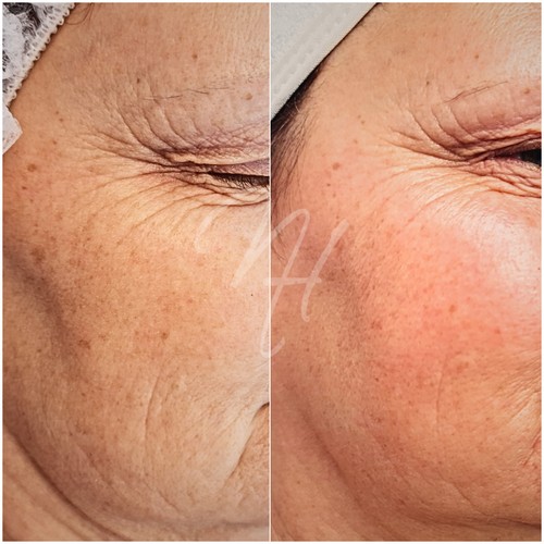 Vorher Nachher — Well-Aging: Fältchen & Hautstraffung (2/7)