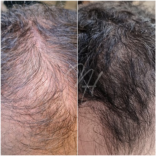 Hautpflege und Beratung rund um die Microneedling-Behandlung