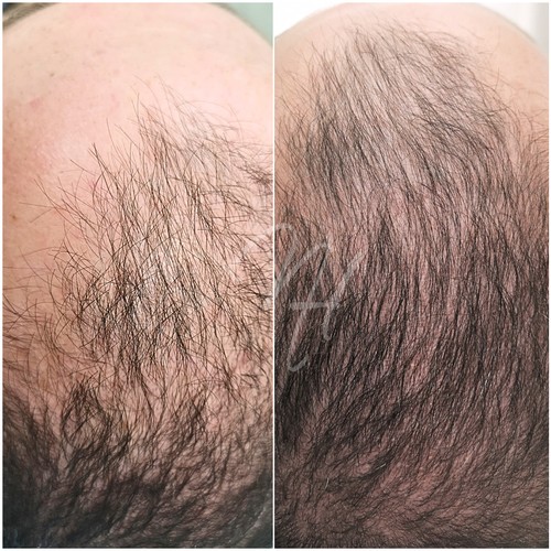 Vorher Nachher — Kopfhaut & Haare (2/5)