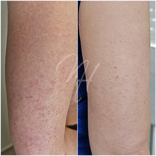Vorher Nachher — Körper-Needling: Cellulite, Hautbild & Dekolleté (7/10)
