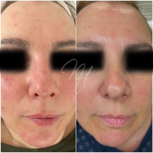 Vorher Nachher — Spa Gesichtsbehandlung (4/8)