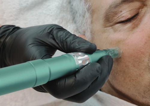 Kosmetisches Microneedling – Art of Beauty Trier