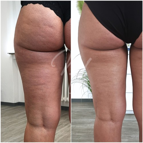 Vorher Nachher — Körper-Needling: Cellulite, Hautbild & Dekolleté (5/10)