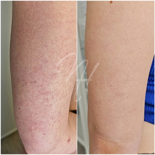 Vorher Nachher — Körper-Needling: Cellulite, Hautbild & Dekolleté (8/10)