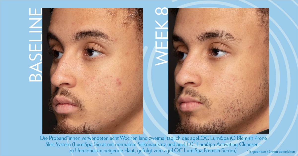 ageLOC LumiSpa Blemish Serum - Anwendungsergebnis (Baseline vs Woche 8)