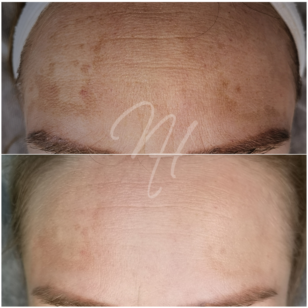 Microneedling Altersflecken / UV-Schäden – Gesicht komplett