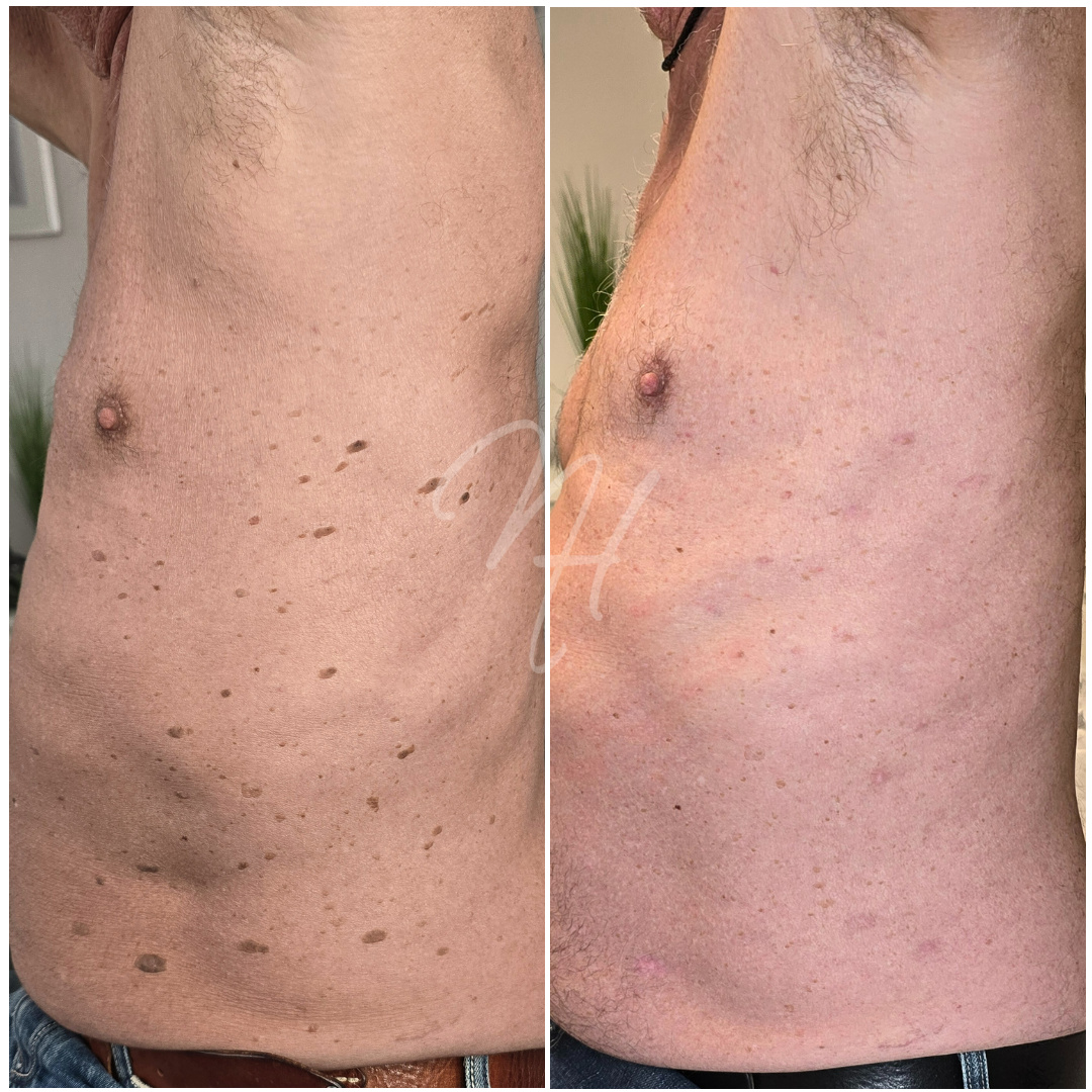 Plasma-Pen für Ihn – Konturen & Straffung