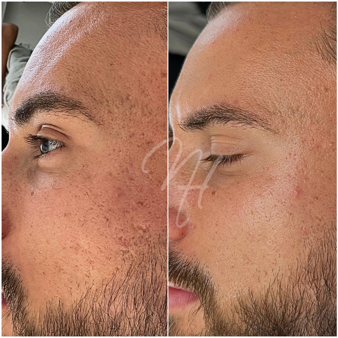 Men's Power-Duo: Microneedling & BioRePeel