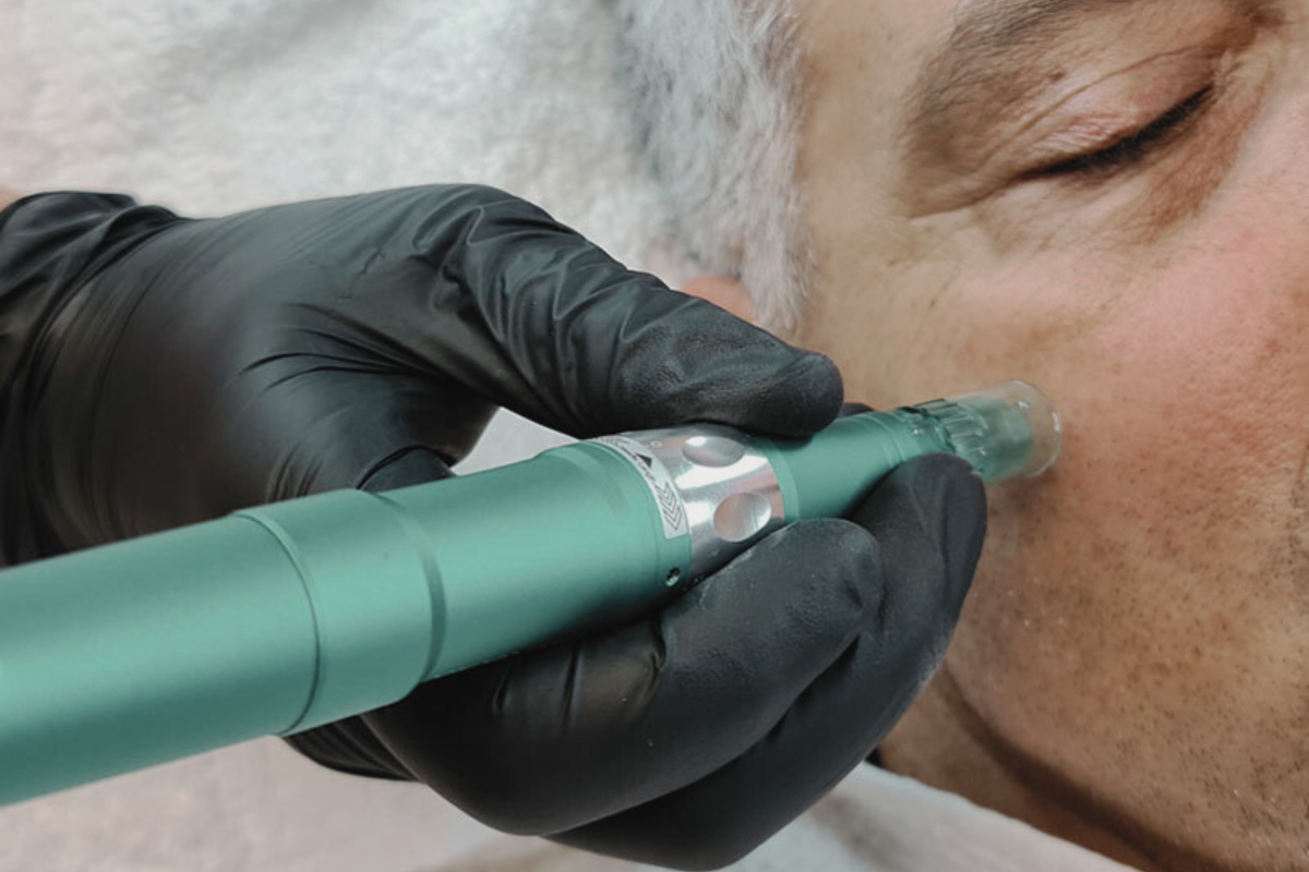 Men's Microneedling – Suavização & Frescura
