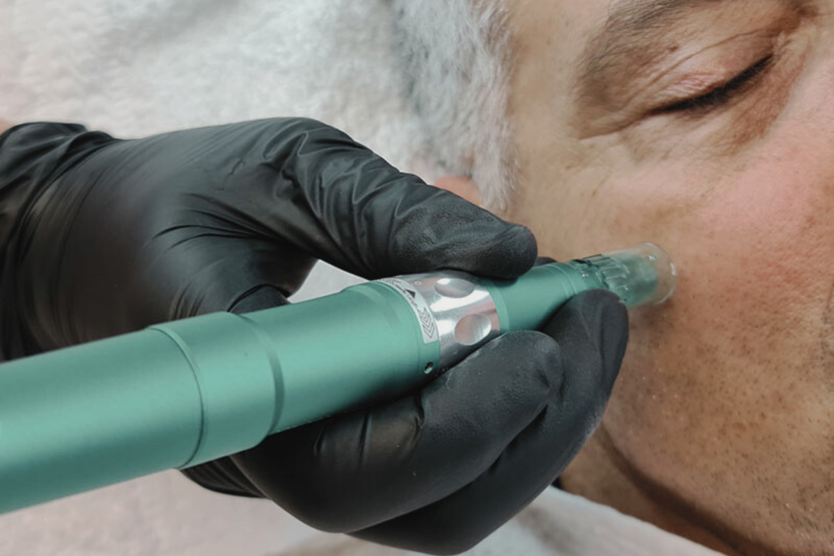 Men's Microneedling – Glättung & Frische