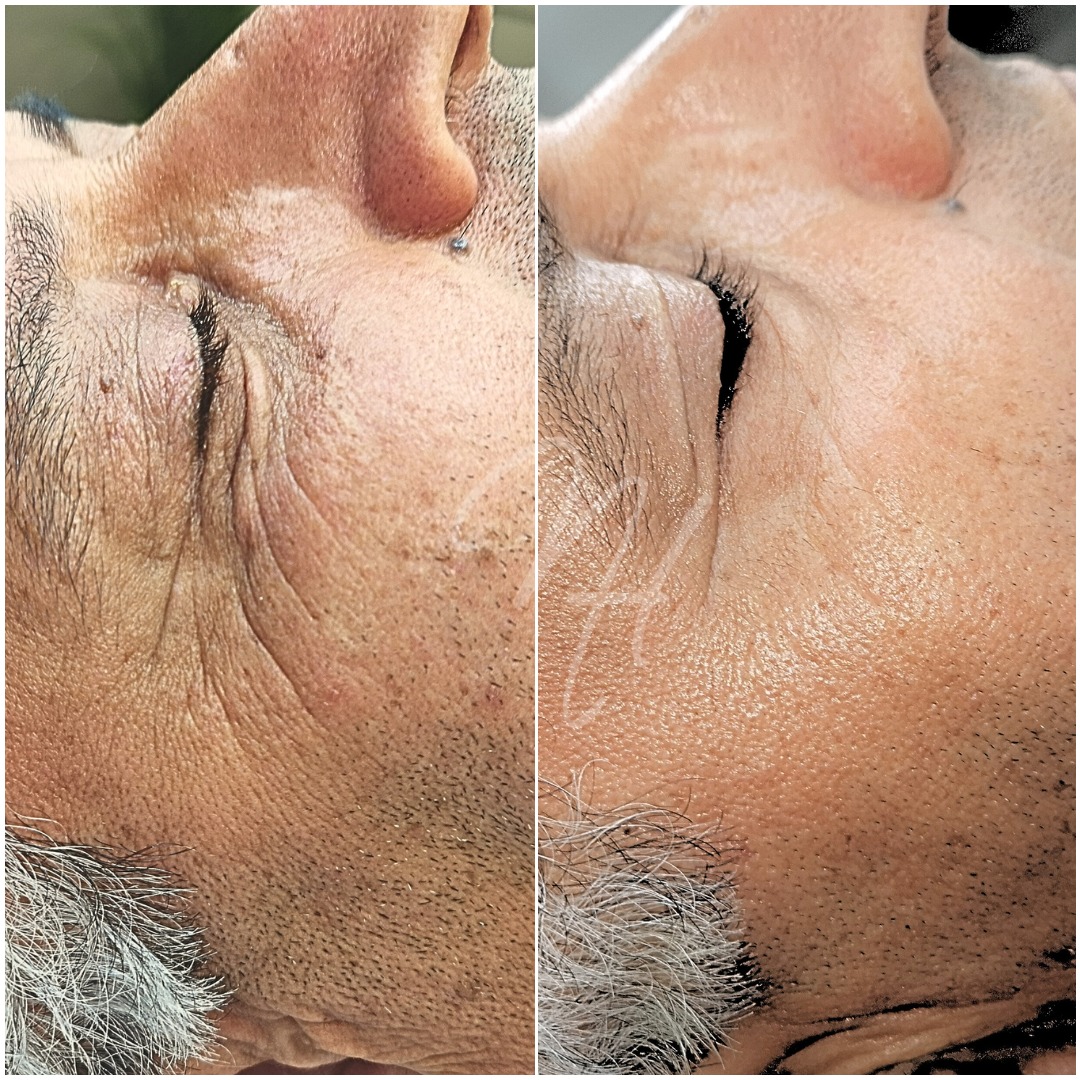 Men's Power-Duo: Microneedling & BioRePeel
