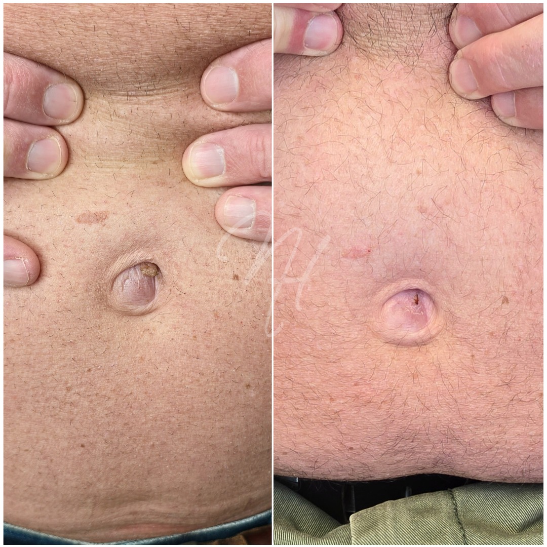 Plasma Pen para Ele – contornos & firmeza