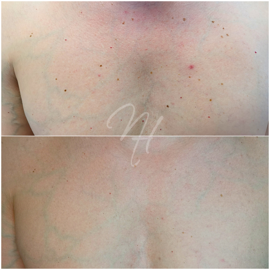 Plasma-Pen für Ihn – Konturen & Straffung