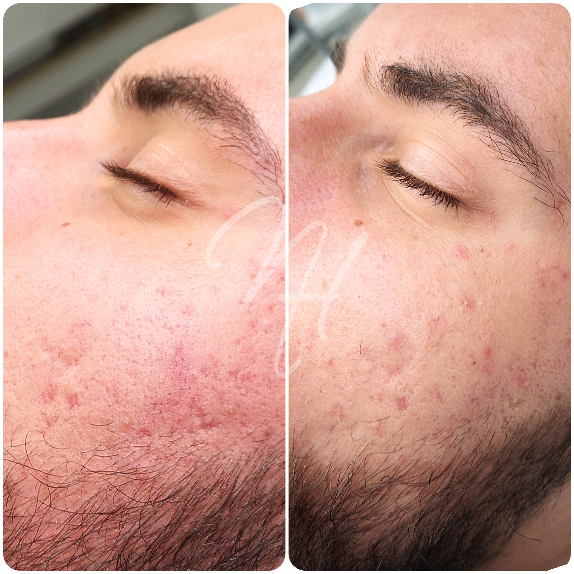 Power Duo masculino: microneedling & BioRePeel