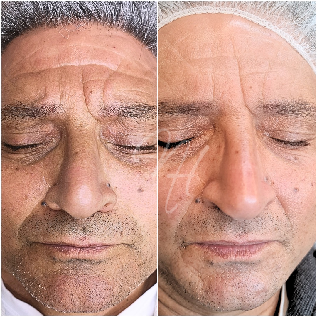 Men's Power-Duo: Microneedling & BioRePeel