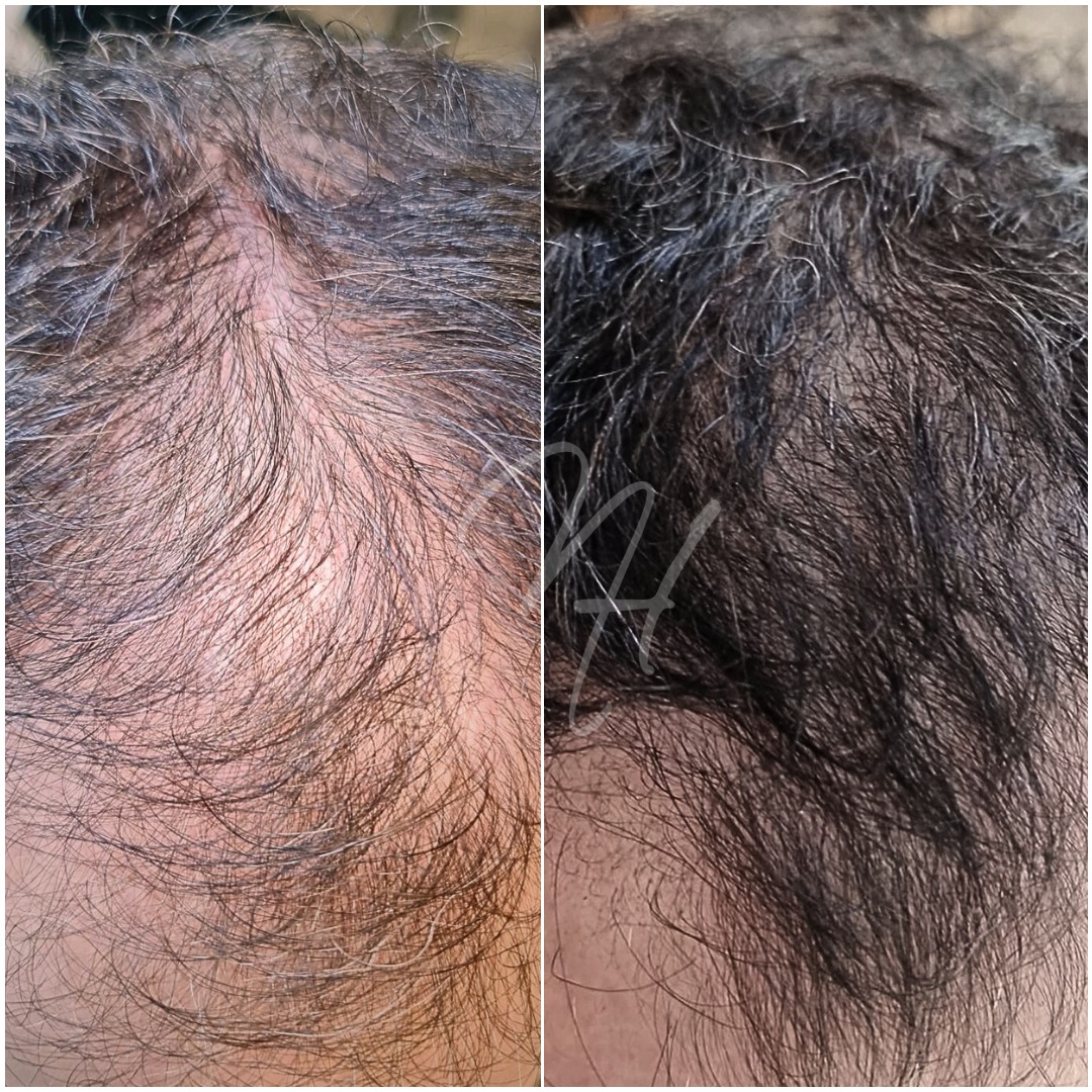 Men's Microneedling – نعومة & نضارة