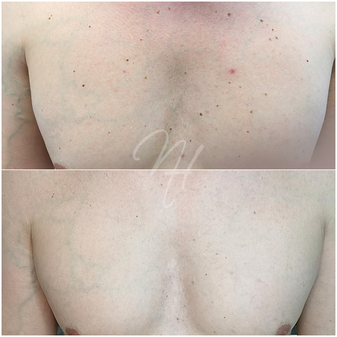 Plasma-Pen für Ihn – Konturen & Straffung