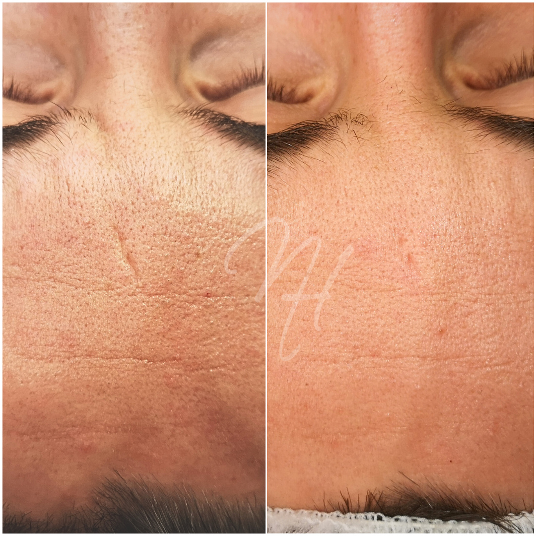 Men's Power-Duo: Microneedling & BioRePeel
