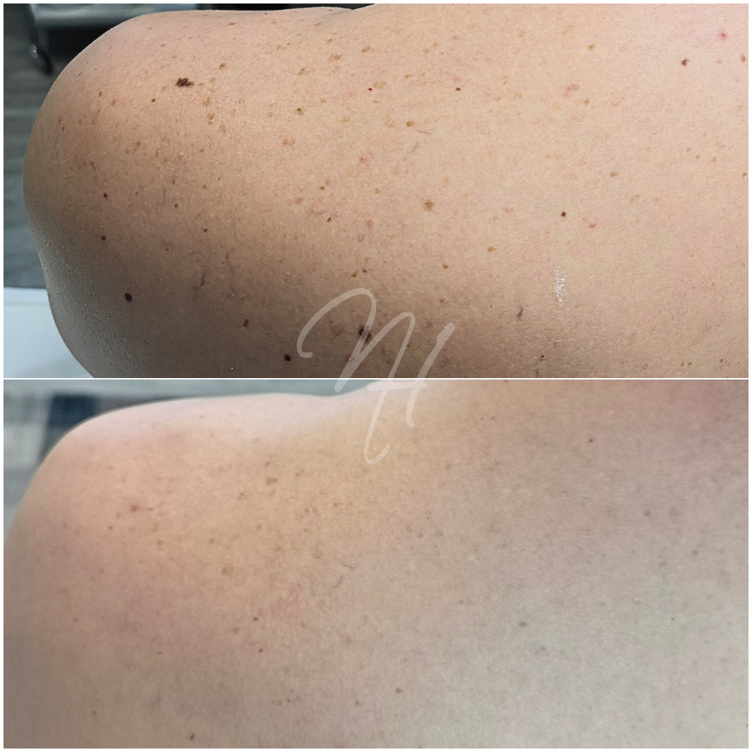 Plasma-Pen für Ihn – Konturen & Straffung