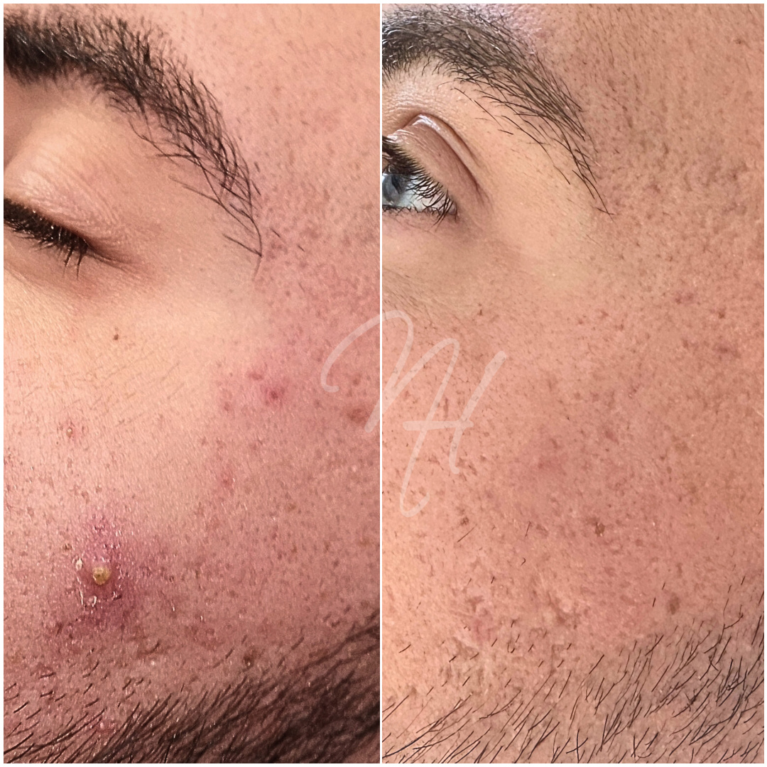 Men's Power-Duo: Microneedling & BioRePeel